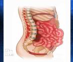 bars procedure to treat abdominal hernia