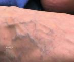 foam injections to erase superficial spider veins