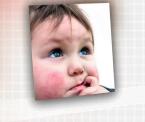 eczema or atopic dermatitis in children