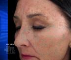 ulthera and visia age defying treatments