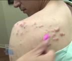 keloid scar tissue treatment