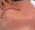 jet peel face treatment