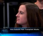 robotic hair transplant