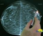 digital mammography seen as superior cancer screening