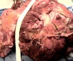 removing a 51 pound tumor