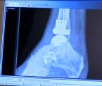 breakthrough foot surgeries arthritic ankle replacements