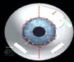 scleral spacing vision procedure