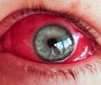 conjunctivitis pink eye