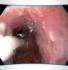 new barretts esophagus treatments
