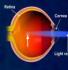 learn about lasik surgery
