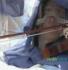 brain surgery for a practicing fiddler