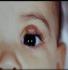 eye capillary hemangiomas in children