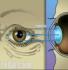 small incision cataract surgery