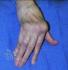 knuckle replacement surgery to relieve arthritic pain