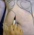 new liposuction gps treatment