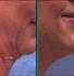 double chin disappear procedure results