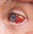 the causes of bloodshot eyes