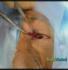 repairing optic nerve injuries
