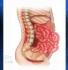 bars procedure to treat abdominal hernia