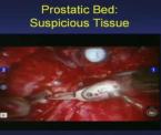 learn about robotic prostatectomy recovery